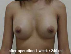 plastic-surgery-breast-augmentation 